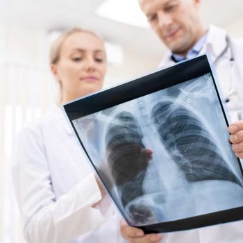 Akciğer Kanserinin Histolojik Özellikleri