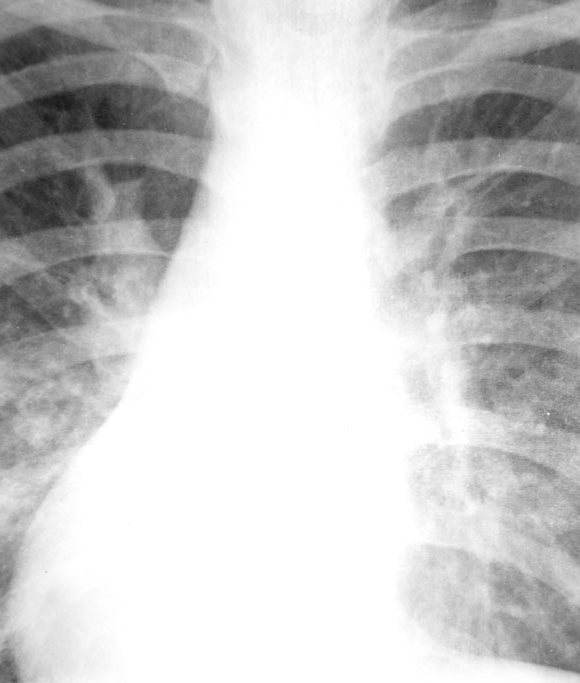 Nedir Bu Akciğer Kanseri?