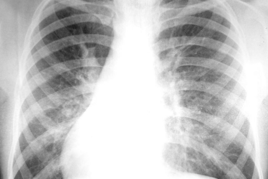 Nedir Bu Akciğer Kanseri?