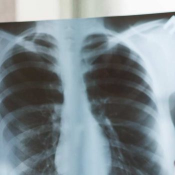Akciğer Kanserinde Semptom ve Bulgular Nelerdir?