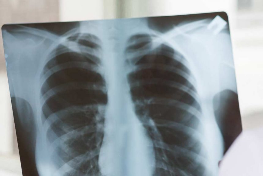 Akciğer Kanserinde Semptom ve Bulgular Nelerdir?