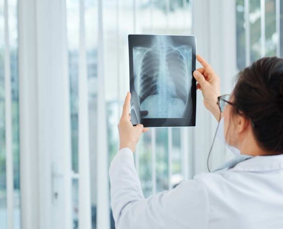 Akciğer Nodülü Nedir? Takip ve Tedavi Yöntemleri Nelerdir?