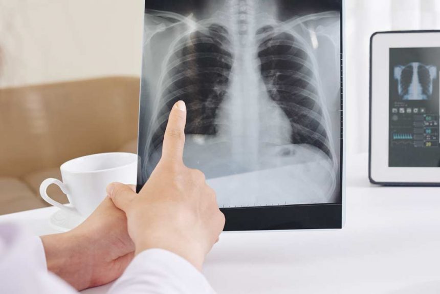 Akciğer Kanserinin Göğüs Kafesi Dışı Yayılımına Bağlı Semptom ve Bulgular