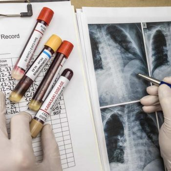 Akciğer Kanserinin Göğüs Kafesi İçine Doğru Yayılımına Bağlı Semptom ve Bulgular
