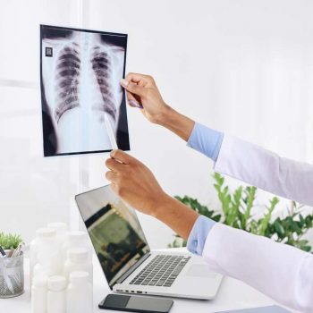 Akciğer Kanserinde Primer Tümöre Bağlı Semptomlar ve Bulgular